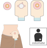 人工肛門(ostomate)