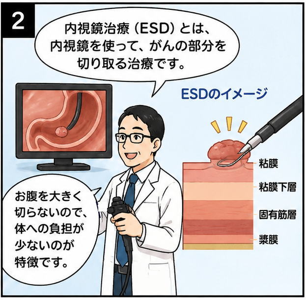 「内視鏡治療（ESD）とは、内視鏡を使って、がんの部分を切り取る治療です。」「お腹を大きく切らないので、体への負担が少ないのが特徴です」と話す白衣を着た男性とESDのイメージのイラスト