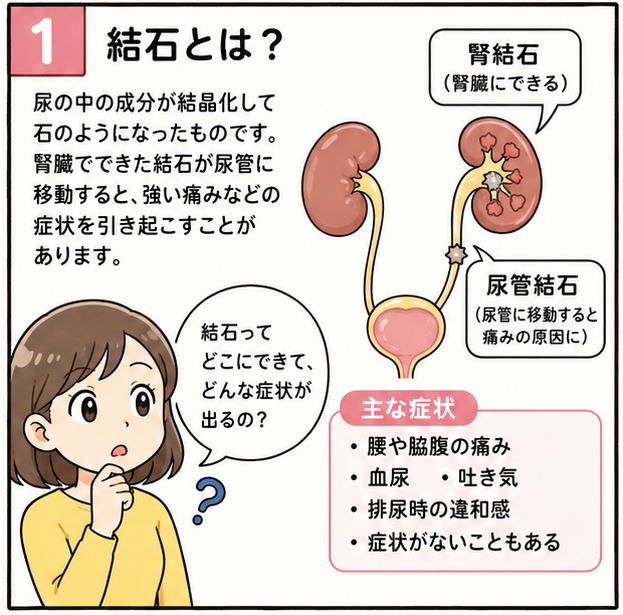 結石とは？というタイトルと、尿の中の成分が結晶化して石のようになったものです。腎臓にできた結石が尿管に移動すると、強い痛みなどの症状を引き起こします。という解説と、腎臓のイラスト