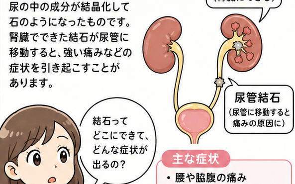 尿の成分が結晶化して石のようになったものです、と結石について解説する女性のイラスト