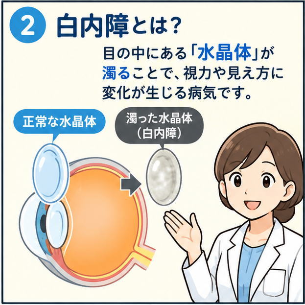 白内障とは何かを解説する漫画。目の中にある水晶体が濁ることで視力や見え方に変化が生じる仕組みを、正常な水晶体と濁った水晶体のイラストで説明。